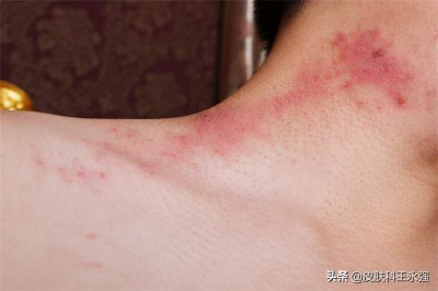 ​疥螨到底是什么？感染后有何症状？这2种传播途径，男女都要小心
