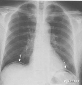 ​3个征象辨识腹腔游离气体