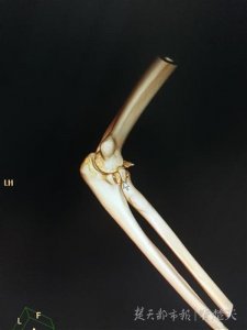 ​520聚餐后，小伙“公主抱”女友胳膊骨折