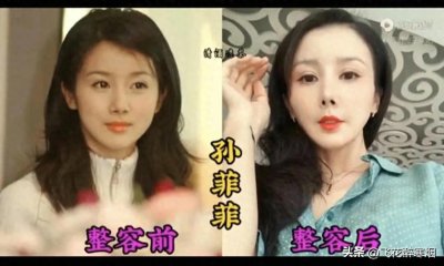 ​10位整容失败的女星，本来很漂亮，被整成了蛇精脸猪鼻子！