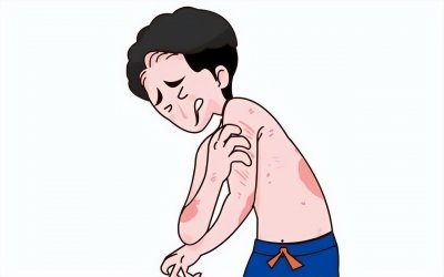 ​速度自查，银屑病好转